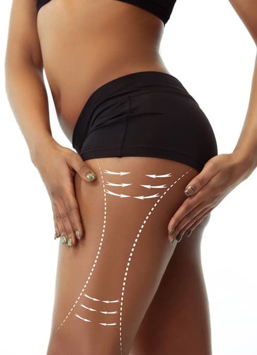 Treatment Carbossiterapia