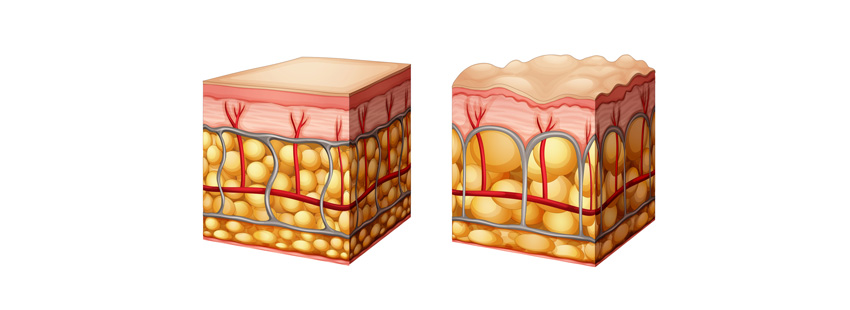 Mesotherapie gegen Cellulite