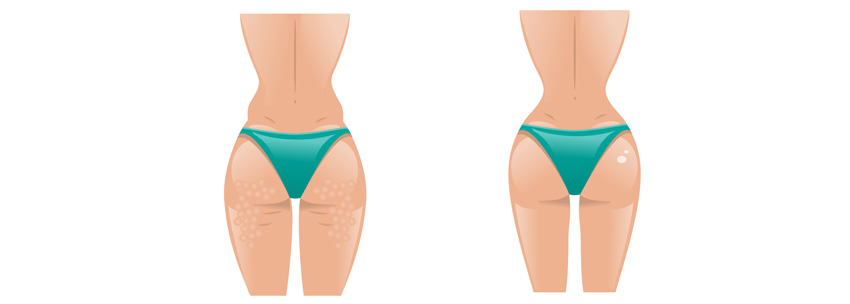 mesoterapia risultati