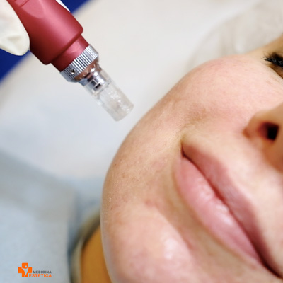 Needling: Wie funktioniert es