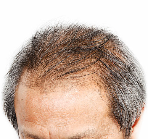PRP-Haar