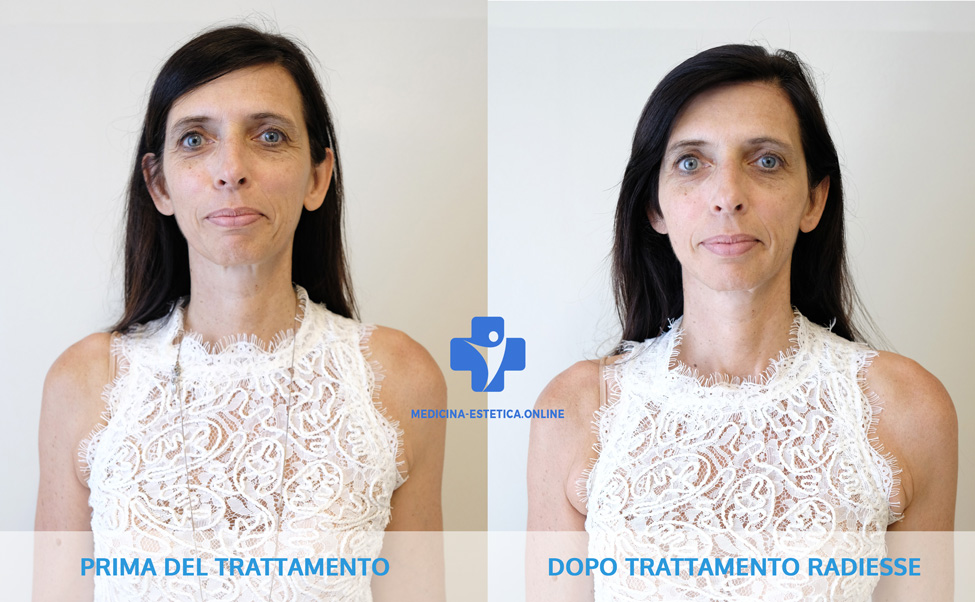radiesse before and after